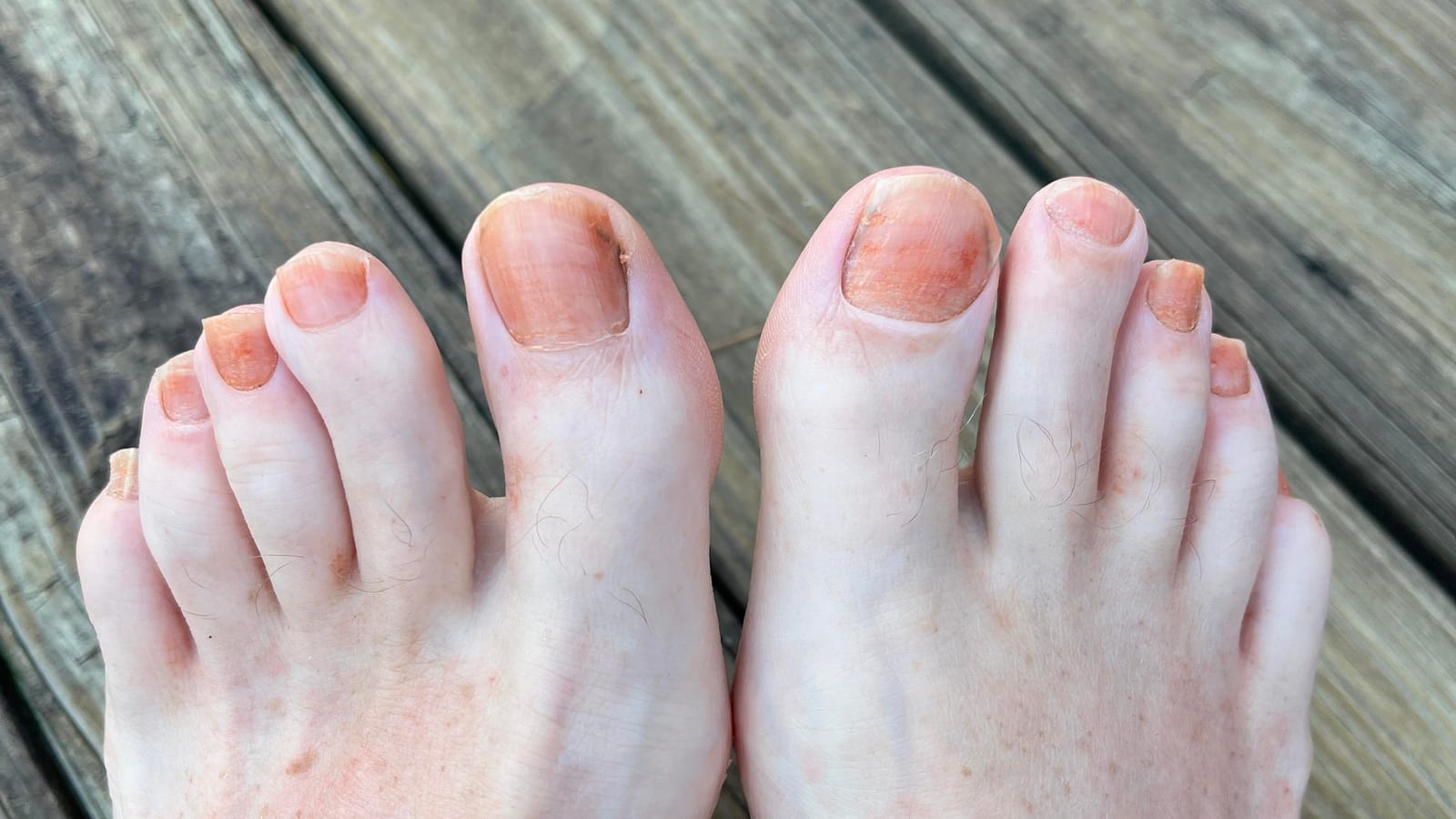 Orange toenails WTF seriously every year